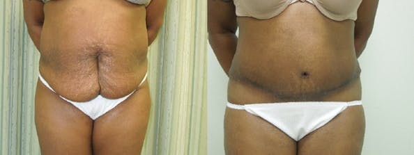 Can Liposuction and Tummy Tuck Surgery Be Done At Same Time?